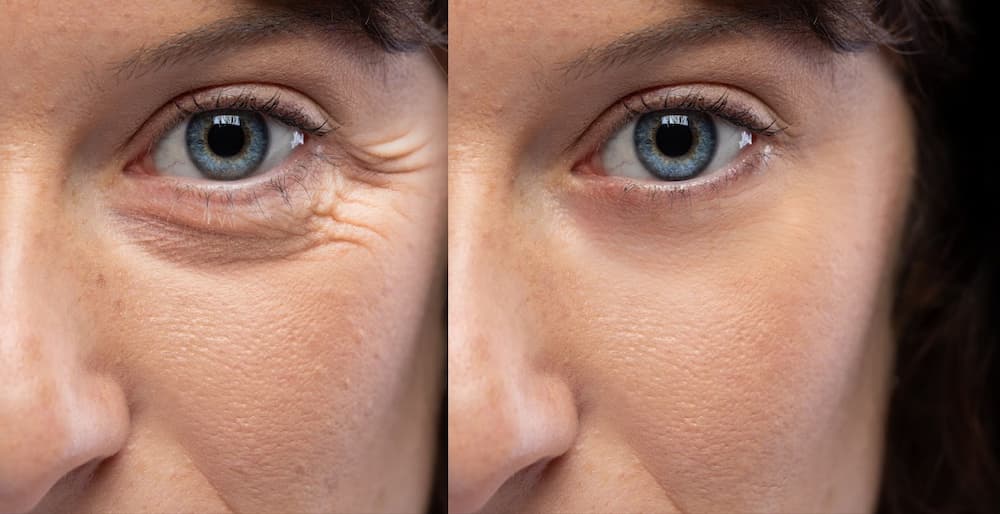 O ChatGPT disse: Close-up before-and-after image of a woman’s eye area showing visible crow’s feet wrinkles on the left and smoother skin after treatment on the right.